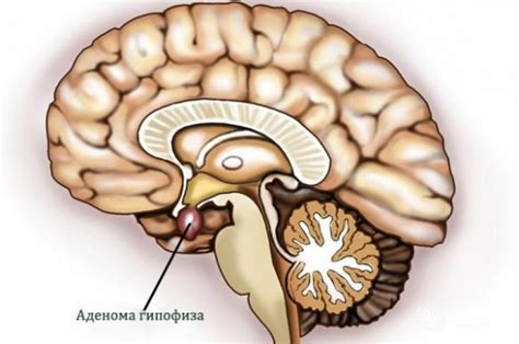 Аденома гипофиза