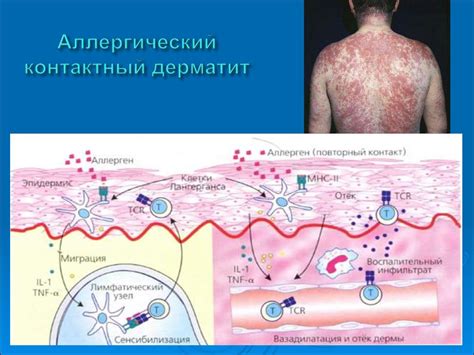 Аллергические реакции и гистамины