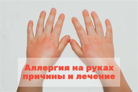 Аллергия на руках: основные причины и методы лечения