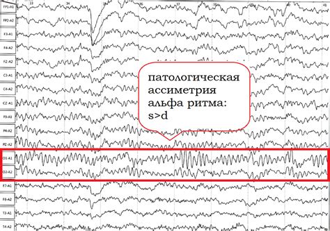 Альтернативные методы стимуляции альфа ритма над левым полушарием