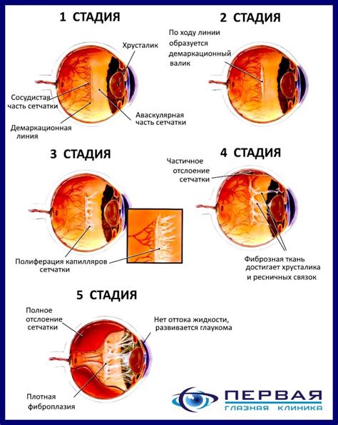 Анаемическая ретинопатия