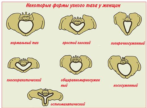 Анатомические особенности мужского широкого таза