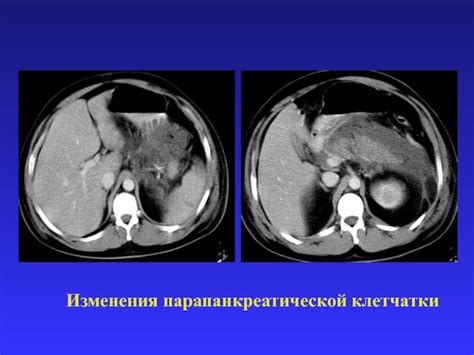 Анатомическое расположение парапанкреатической клетчатки