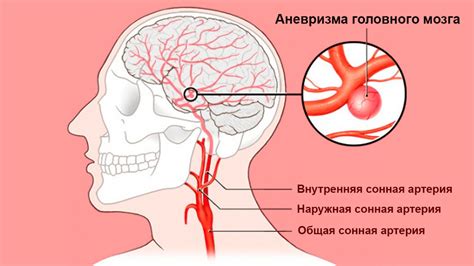 Аневризма: симптомы и последствия