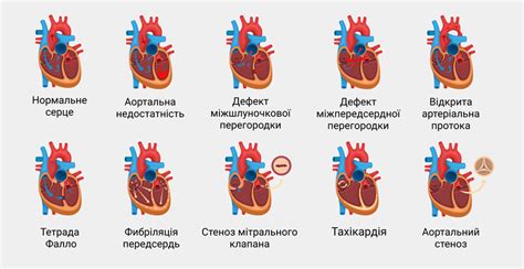 Аномалии порога сердца у новорожденного: классификация