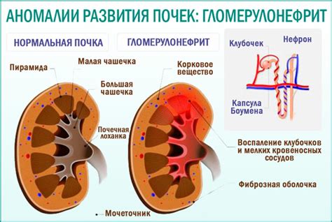 Аномалии почек и их симптомы