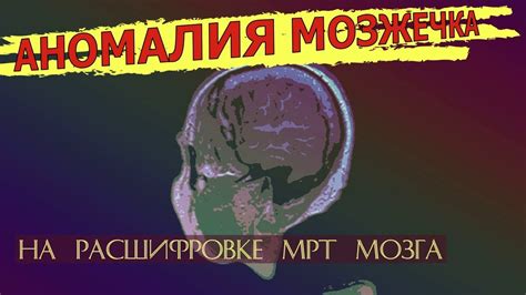 Аномалия развития мозга