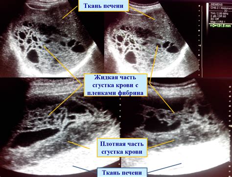 Анэхогенные включения в печени и почках