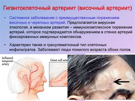 Артериит как причина боли в левой части головы