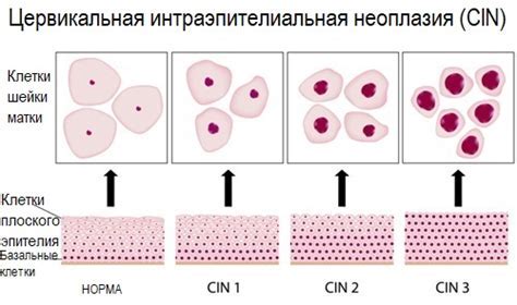 Атипичность плоского эпителия: факторы риска и влияние