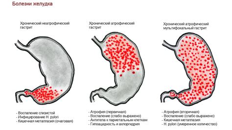 Атрофический антрум гастрит