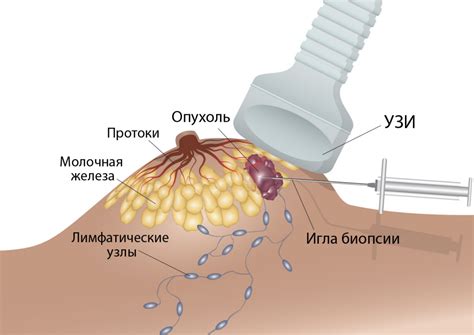 Аугментация молочных желез: для чего нужна процедура?