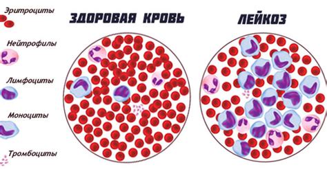 Белокровие: понятие, факторы и перебирающие его виды