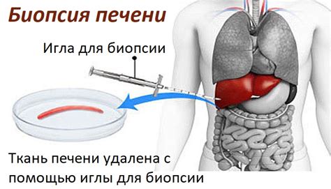 Биопсия печени - определение и принцип