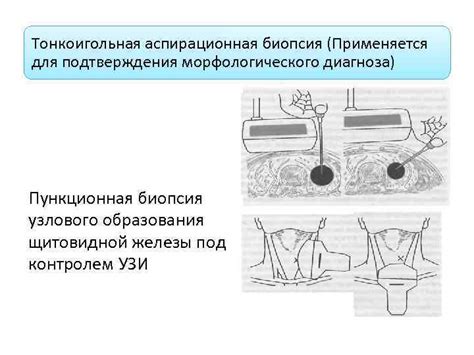 Биопсия щитовидной железы для подтверждения диагноза аутоиммунного тиреоидита