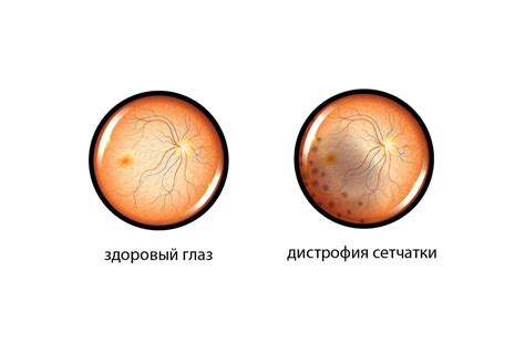 ВМД (возрастная макулодистрофия) в офтальмологии