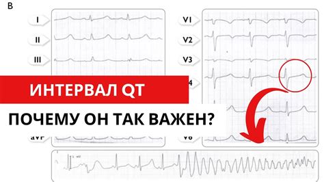 Важность предотвращения укорочения интервала QT