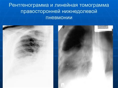 Важные факты о нижнедолевой пневмонии слева