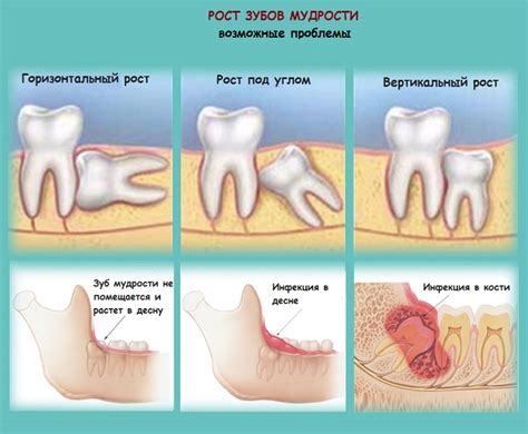 Варианты лечения гнилого зуба мудрости