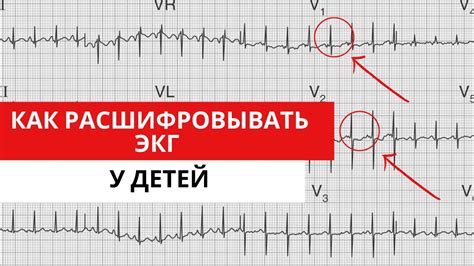 Варианты отклонений от нормы в ЭКГ у детей