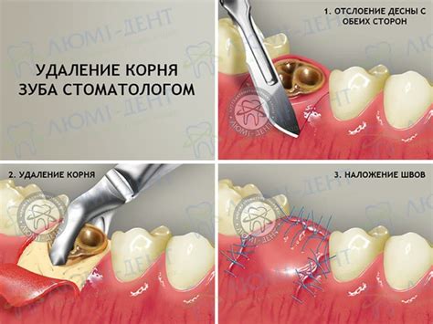 Варианты снов о удалении зубов из полости рта