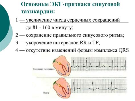 Вертикальная эос синусовой тахикардии