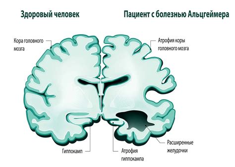 Взаимосвязь между ожирением и сильной изжогой