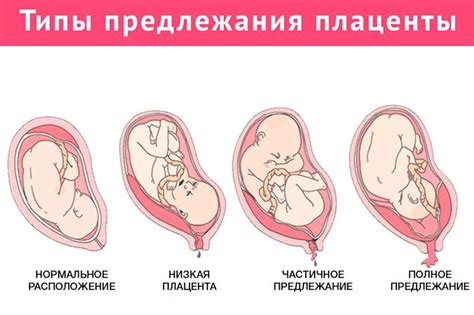 Взаимосвязь рыхлой структуры плаценты с проблемами беременности