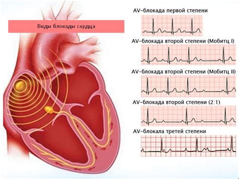 Виды блокад сердца у ребенка