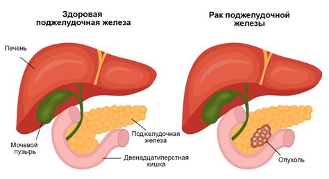 Виды диффузного изменения поджелудочной железы