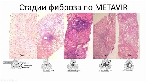 Виды диффузных изменений и их особенности на эхограмме