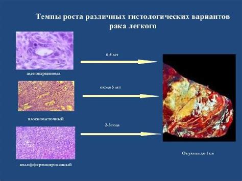 Виды лечения плоскоклеточного рака с распадом