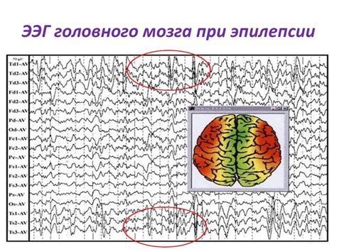 Виды нарушений в результате проведения ЭЭГ и их влияние на эпиактивность