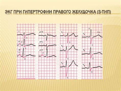 Виды нарушений левого предсердия на ЭКГ: детальный анализ