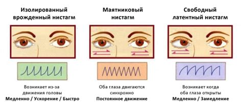 Виды нистагма и их особенности