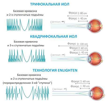 Виды оптической коррекции кривой дефокуса