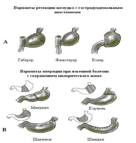 Виды резекции желудка