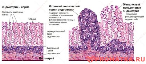 Виды функционального полипа эндометрия