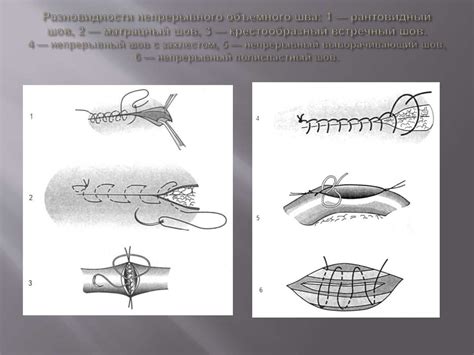 Виды швов в медицине