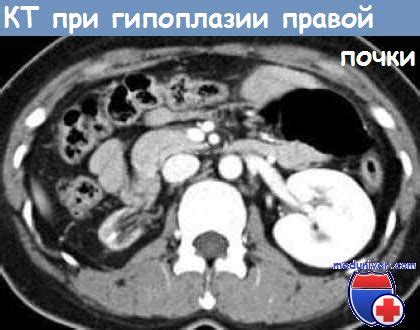 Викарная гиперплазия правой почки