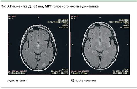 Висцеральный криз в онкологии: симптомы и причины