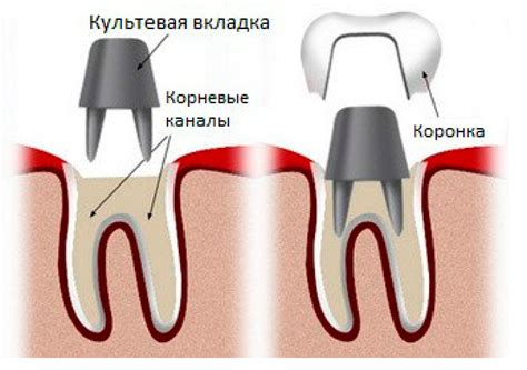 Вкладка в зуб: особенности, назначение и процесс установки