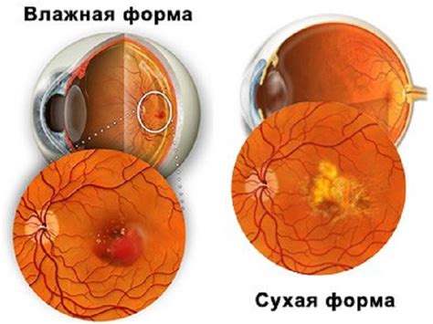 Влажная макулодистрофия сетчатки: общая информация