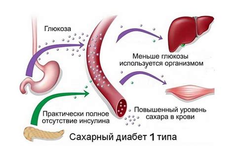 Влияет ли сахар первого типа на развитие диабета?