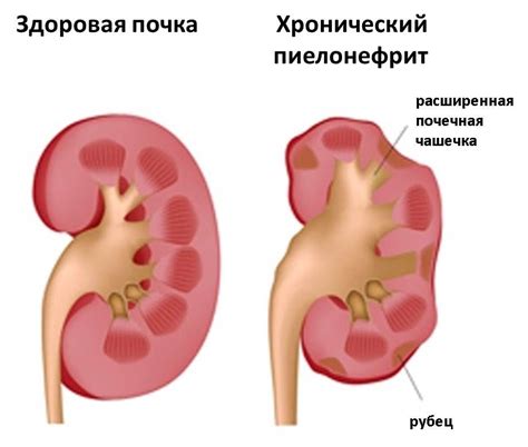 Влияние алкоголя на почки