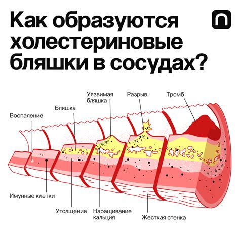 Влияние атерогенности на процесс образования холестериновых бляшек