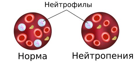 Влияние высокого уровня нейтрофилов на организм