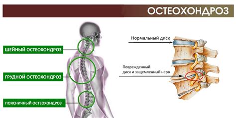 Влияние компрессии корешков на позвоночник