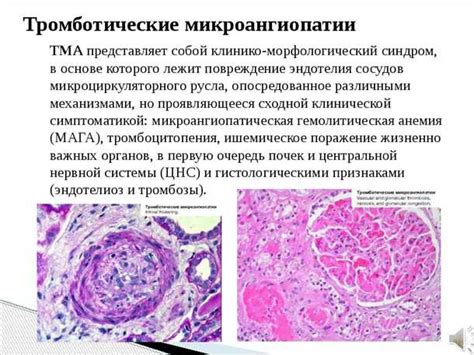 Влияние микроангиопатии головного мозга на качество жизни