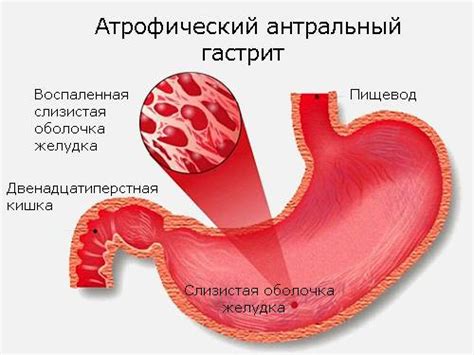 Влияние пищи на жжение при гастрите